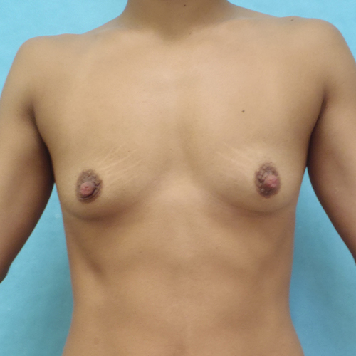 Breast Augmentation Patient