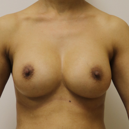 Breast Augmentation Patient
