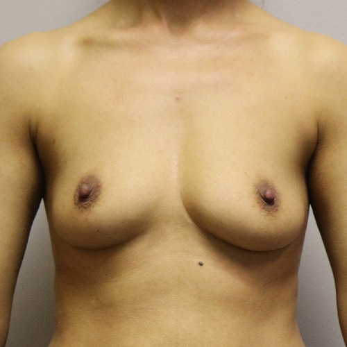 Breast Augmentation Patient