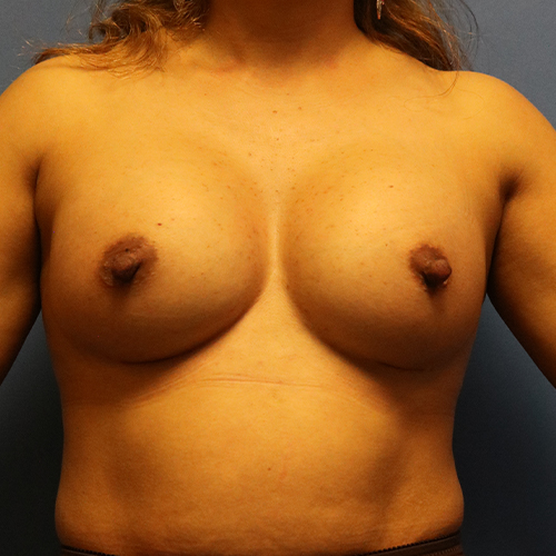 Breast Augmentation Patient