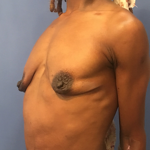 Breast Augmentation Patient