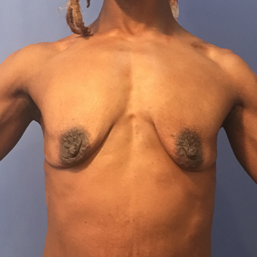 Breast Augmentation Patient