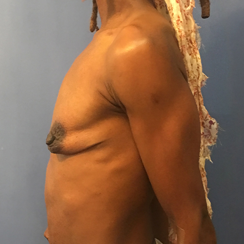 Breast Augmentation Patient