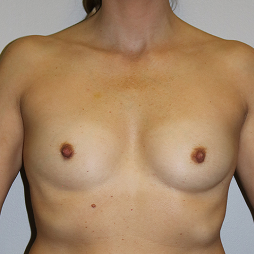 Breast Augmentation Patient