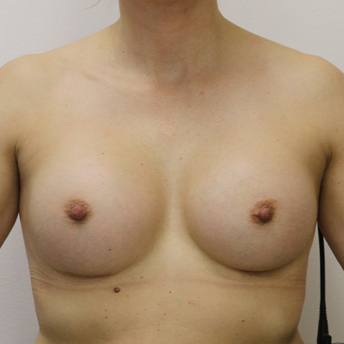 Breast Augmentation Patient