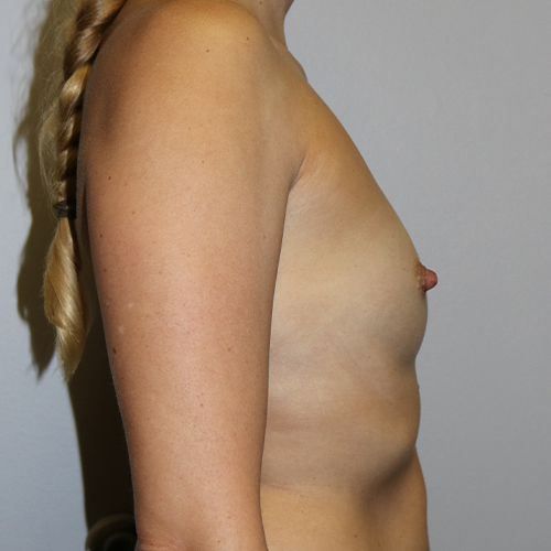 Breast Augmentation Patient