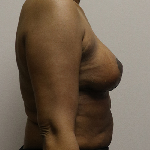 Breast Lift Patient