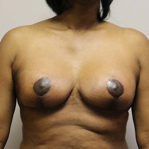 Breast Lift Patient