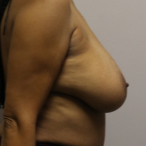 Breast Lift with Implants Patient