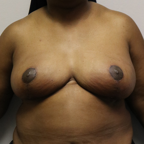 Breast Reduction Patient