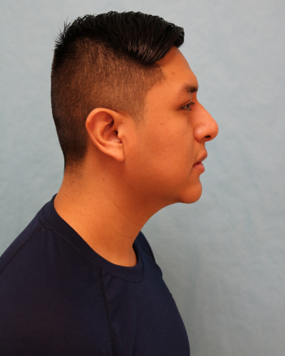 Chin Augmentation Patient