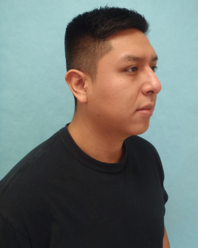 Chin Augmentation Patient