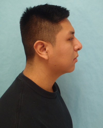 Chin Augmentation Patient