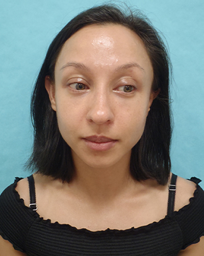 Chin Augmentation Patient