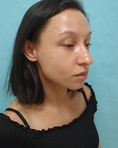 Chin Augmentation Patient