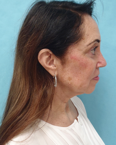 facelift patient
