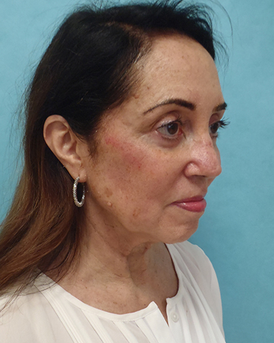 facelift patient