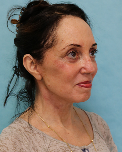 facelift patient