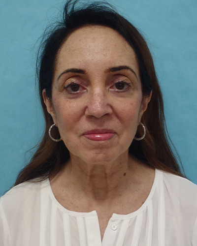 facelift patient