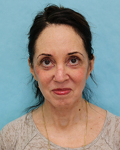 facelift patient