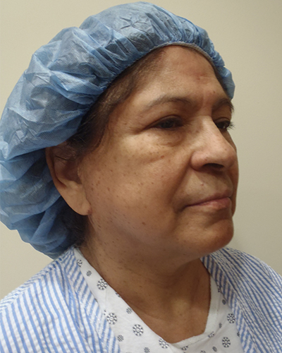 facelift patient
