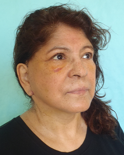 facelift patient