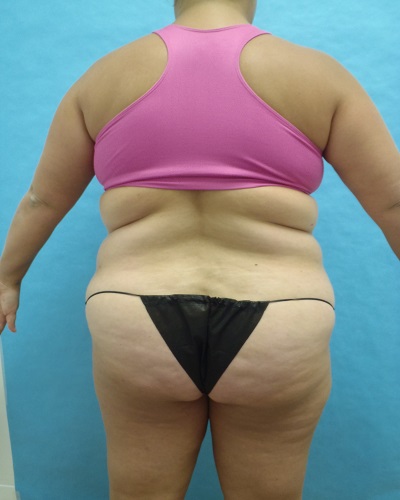 Liposuction Patient