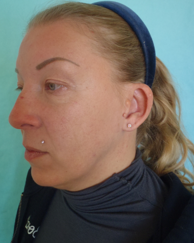 Otoplasty Patient