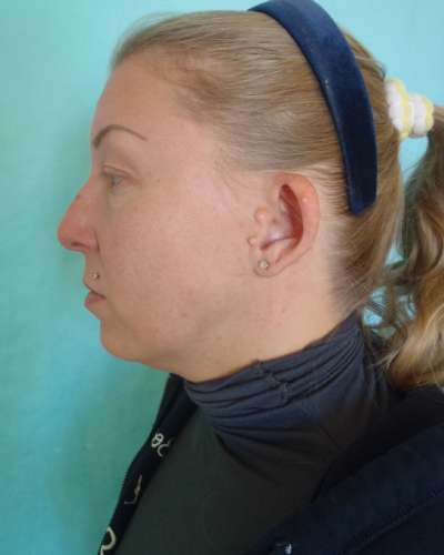 Otoplasty Patient