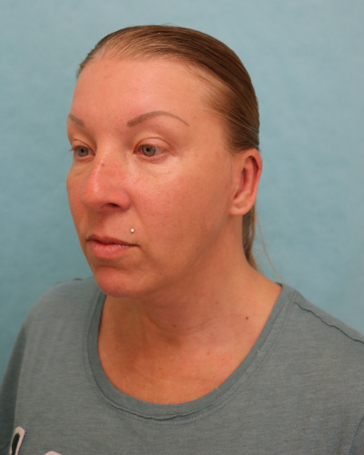 Otoplasty Patient