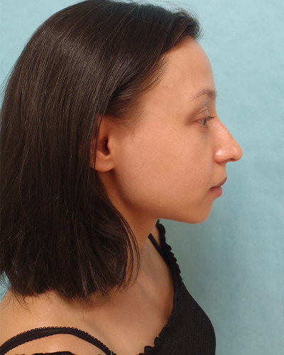 Rhinoplasty Patient