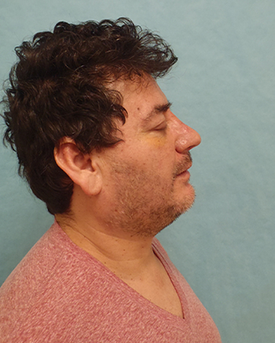 Rhinoplasty Patient