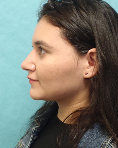 Rhinoplasty Patient
