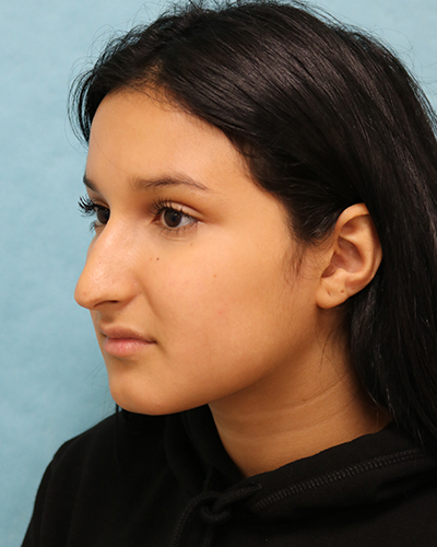 Rhinoplasty Patient