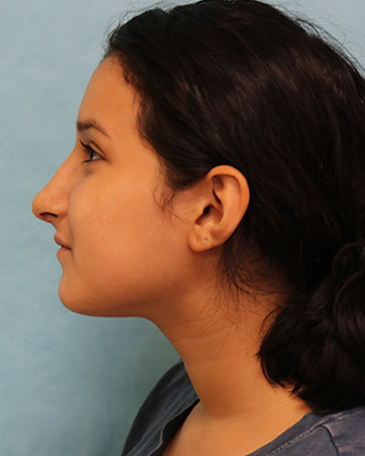 Rhinoplasty Patient