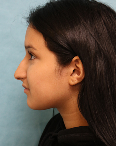 Rhinoplasty Patient