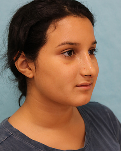 Rhinoplasty Patient
