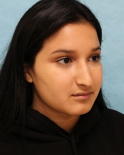 Rhinoplasty Patient