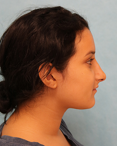 Rhinoplasty Patient