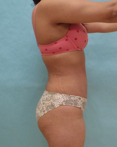 tummy tuck patient