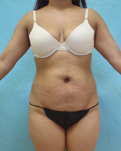 tummy tuck patient