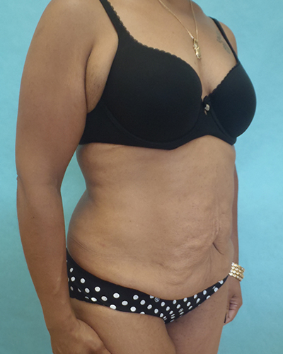 tummy tuck patient
