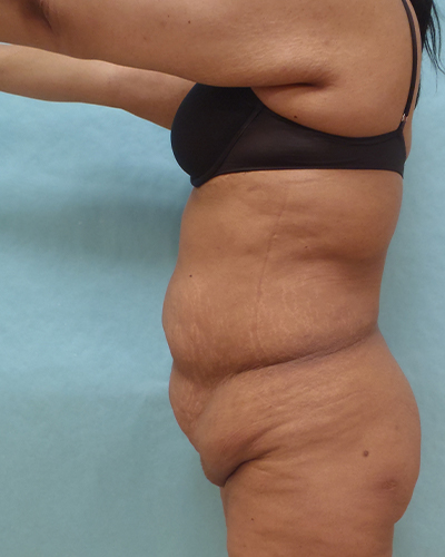 tummy tuck patient
