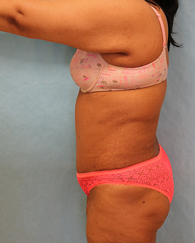 tummy tuck patient