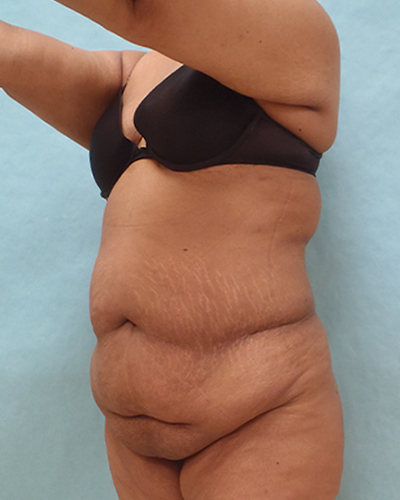 tummy tuck patient