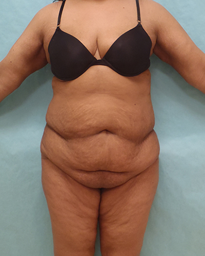 tummy tuck patient