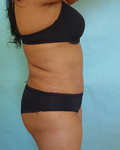 tummy tuck patient