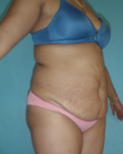 tummy tuck patient