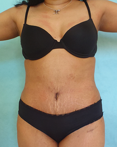 tummy tuck patient