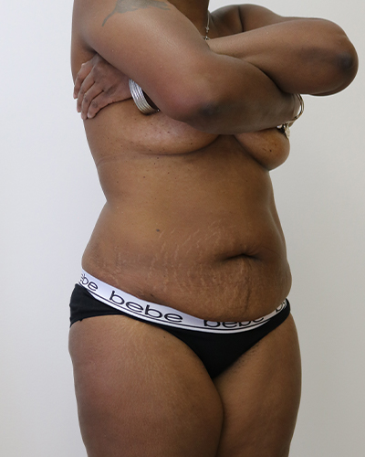 tummy tuck patient